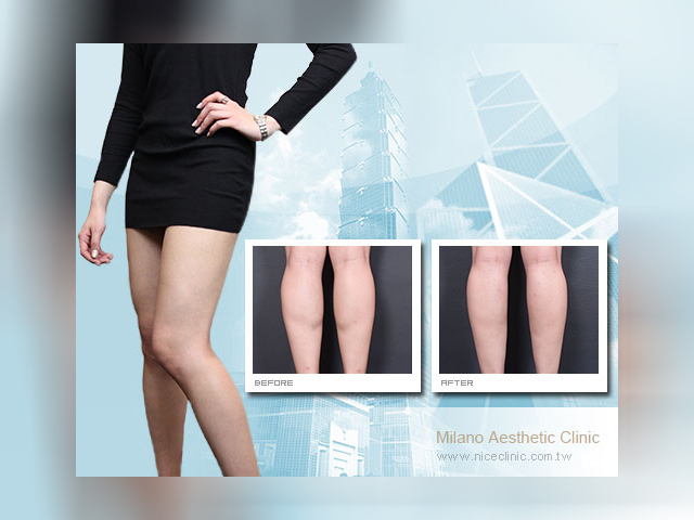 香港Una專程來台瘦小腿打造名模美腿推薦