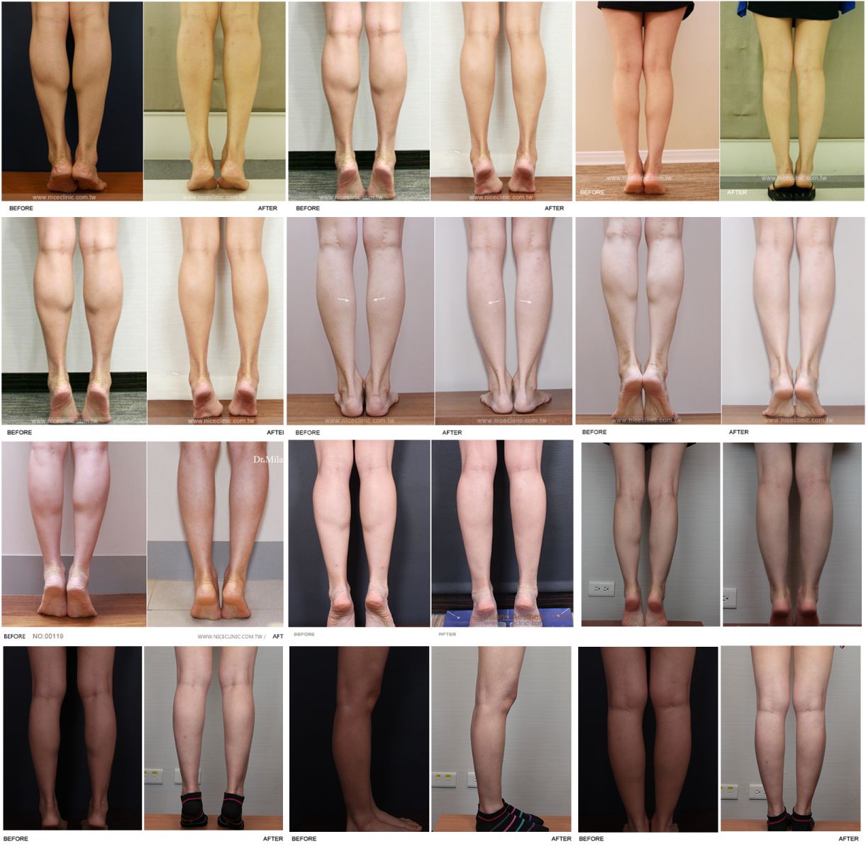 米蘭時尚診所擁有眾多瘦小腿成功案例圖片