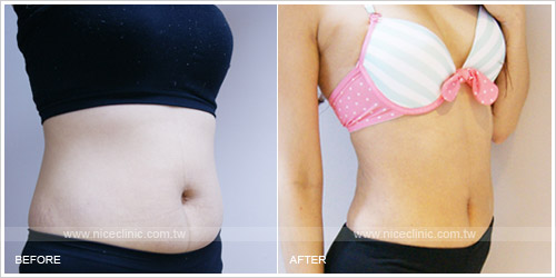 Fatsol飛塑® 減脂瘦小腹術後一個月