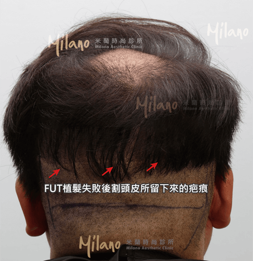 FUT植髮失敗後割頭皮所留下來的疤痕
