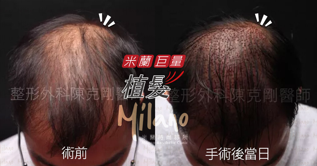 FUE植髮，頭頂稀疏的患者 圖片