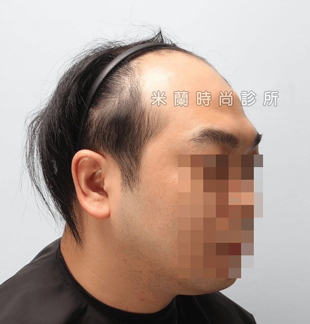 雄性禿第五期FUE巨量植髮術前左側