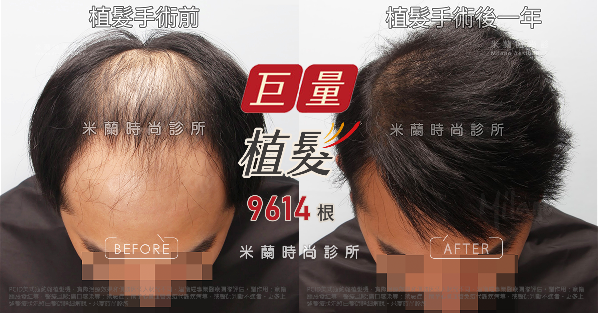 植髮手術後一年低頭比較