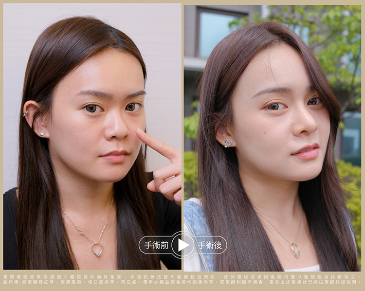 FITme隆鼻完形美術前術後比一比
