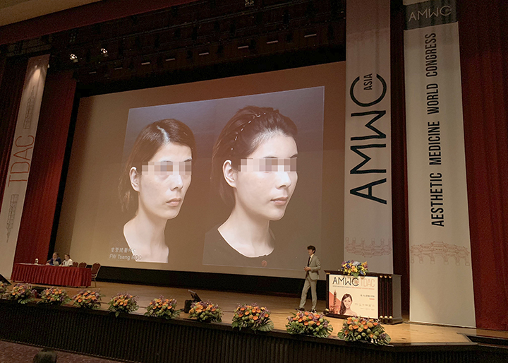 曾繁聞醫師於AMWC美容醫學世界高峰會亞洲年會演講 額頭微整塑型技術