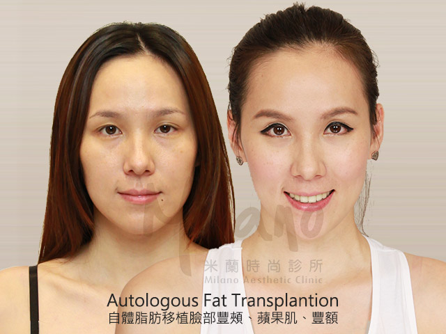 自體脂肪移植技術推薦