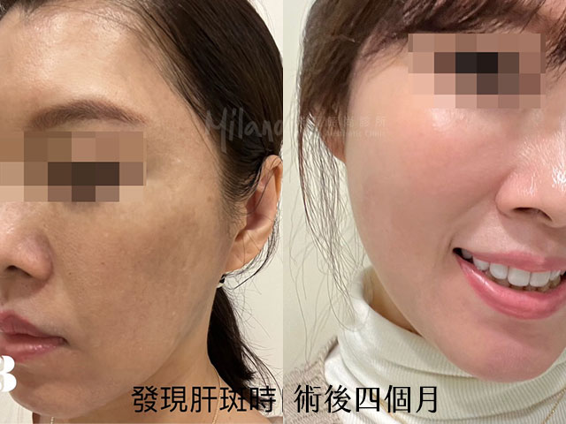 改善肝斑案例分享