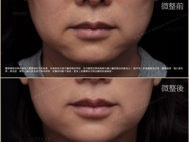 玻尿酸性感豐唇
