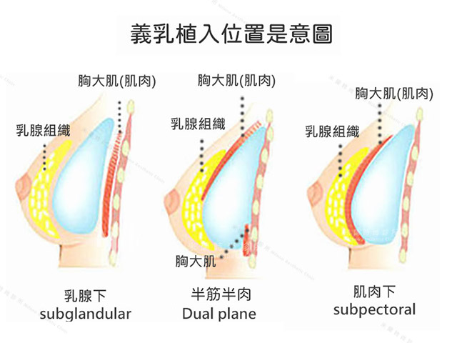 隆乳植體放置位置解析