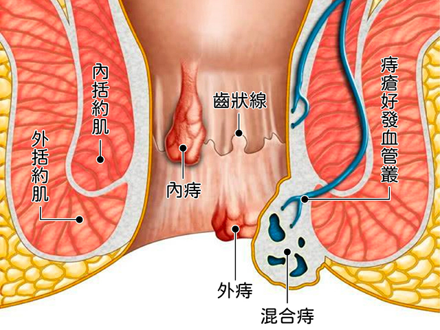 痔瘡分類