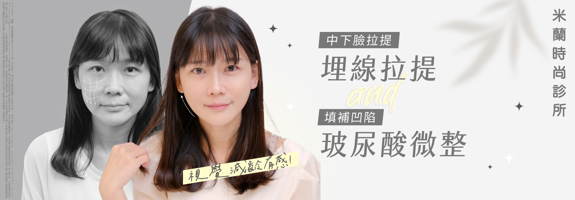 埋線拉提搭配玻尿酸