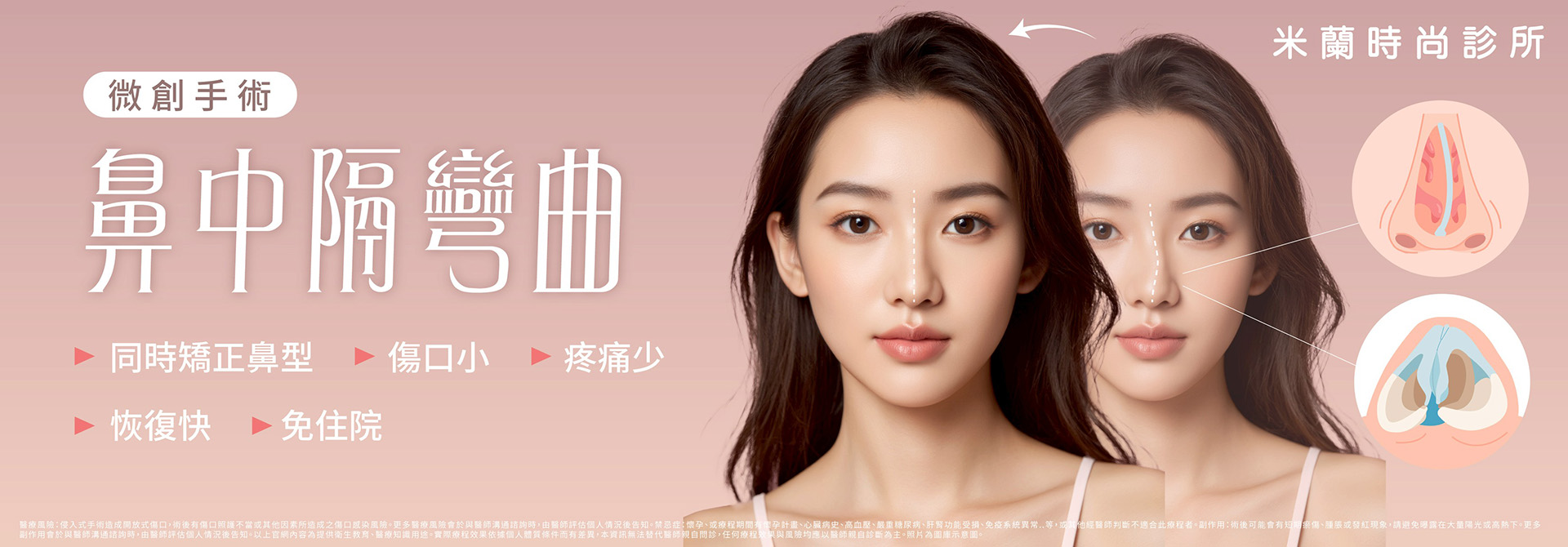 鼻中膈彎曲