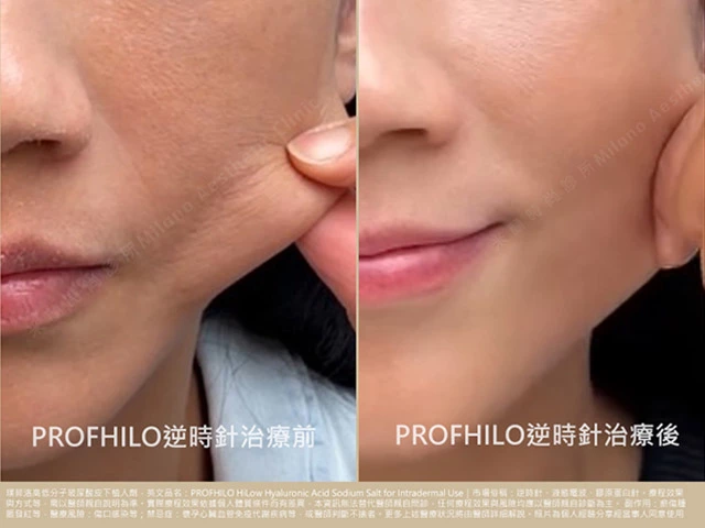 逆時針PROFHILO彈力實測
