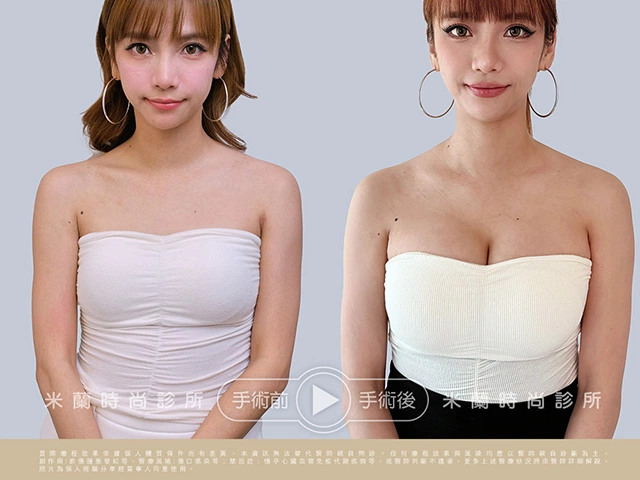 張琳魔滴絕世好波隆乳術後自信展現自然動態美胸