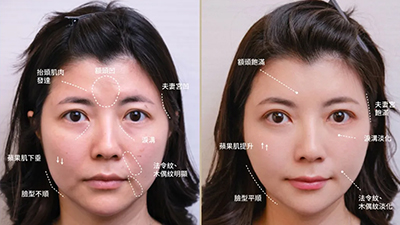 微整偷偷變美解密大公開~洪寬哲醫師
