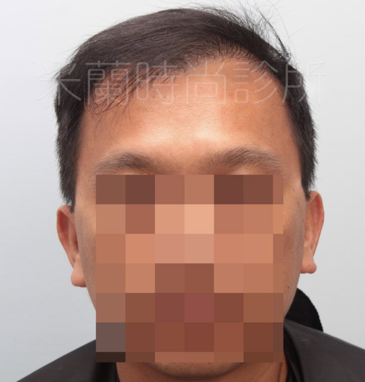 低頭可以看到除了M型髮線之外，頭頂也禿了一塊