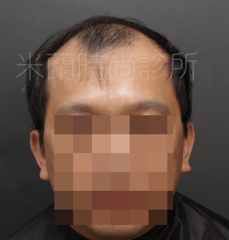 低頭可以看到除了M型髮線之外，頭頂也禿了一塊