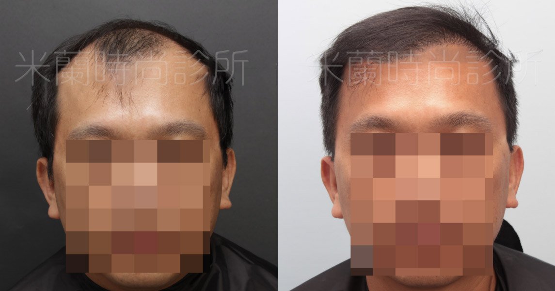 低頭可以看到除了M型髮線之外，頭頂也禿了一塊