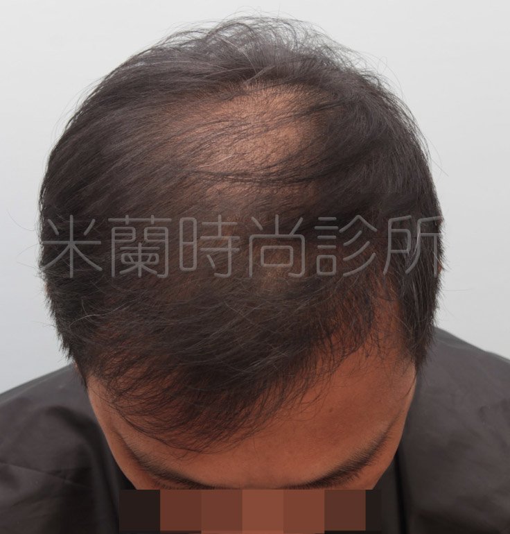 低頭可以看到除了M型髮線之外，頭頂也禿了一塊