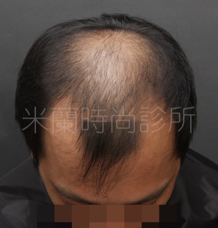 低頭可以看到除了M型髮線之外，頭頂也禿了一塊