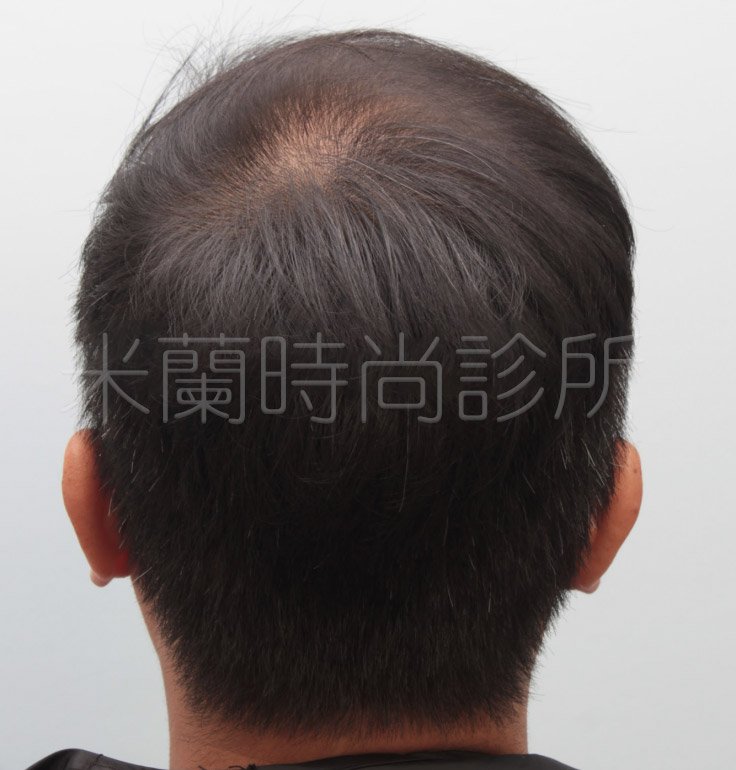 低頭可以看到除了M型髮線之外，頭頂也禿了一塊