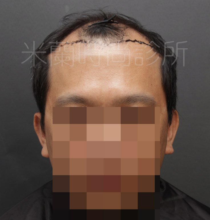 低頭可以看到除了M型髮線之外，頭頂也禿了一塊