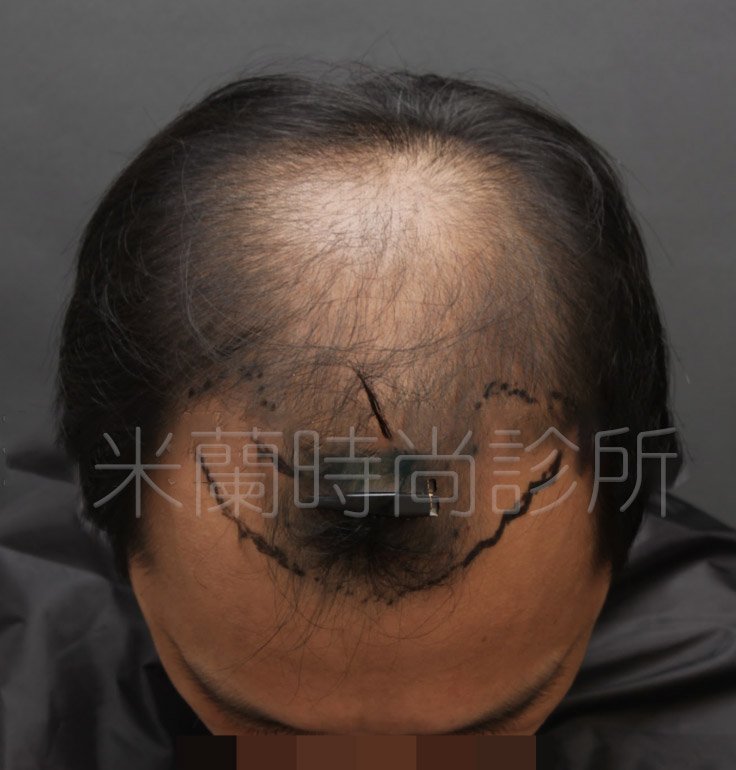 低頭可以看到除了M型髮線之外，頭頂也禿了一塊