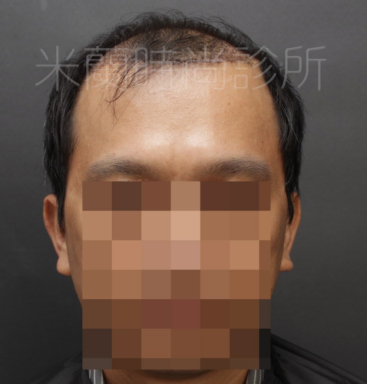 低頭可以看到除了M型髮線之外，頭頂也禿了一塊