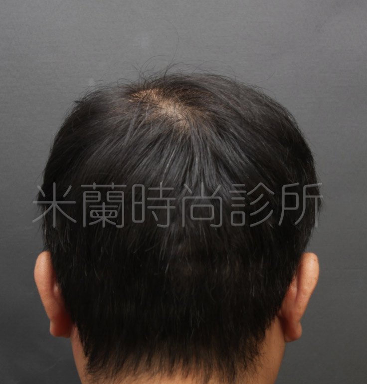 低頭可以看到除了M型髮線之外，頭頂也禿了一塊