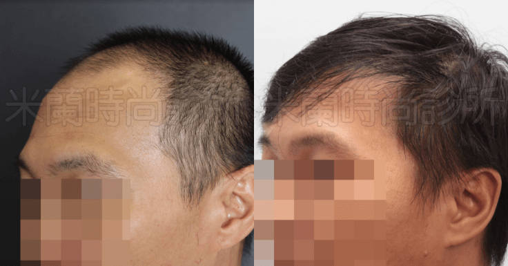 FUE寇約翰植髮術前術後兩相對比之下