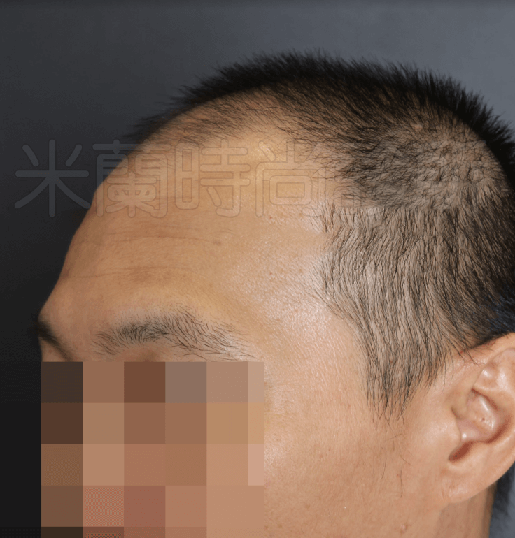 FUE寇約翰植髮術前照片