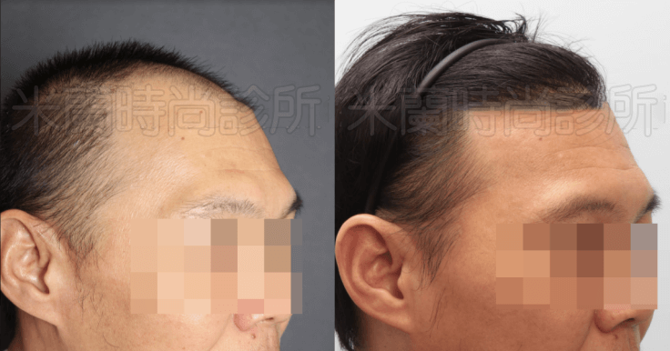 FUE寇約翰植髮術前術後兩相對比之下