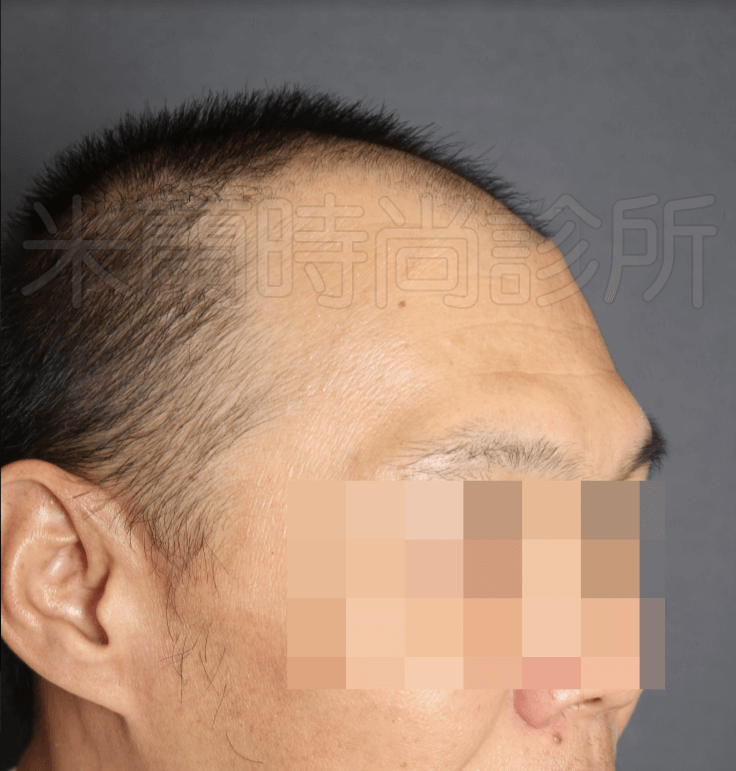FUE寇約翰植髮術前照片