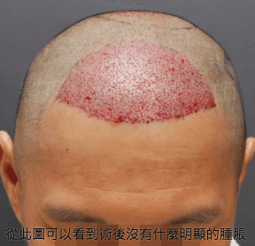 從此圖可以看到術後沒有什麼明顯的腫脹