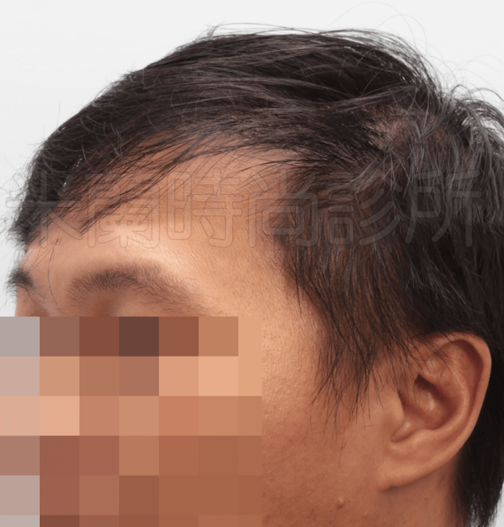 頭髮放下來從側面看沒有破綻