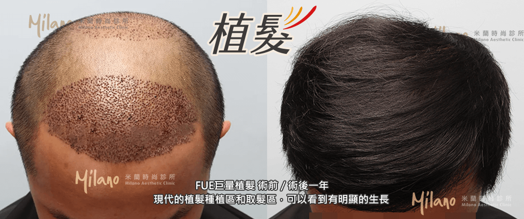 FUE寇約翰植髮 術前/術後 一年可以看到頭髮有明顯的生長