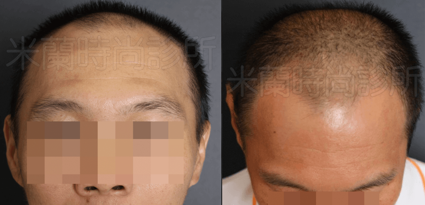 口服藥物和生髮水,但是前額改善效果都不太顯著