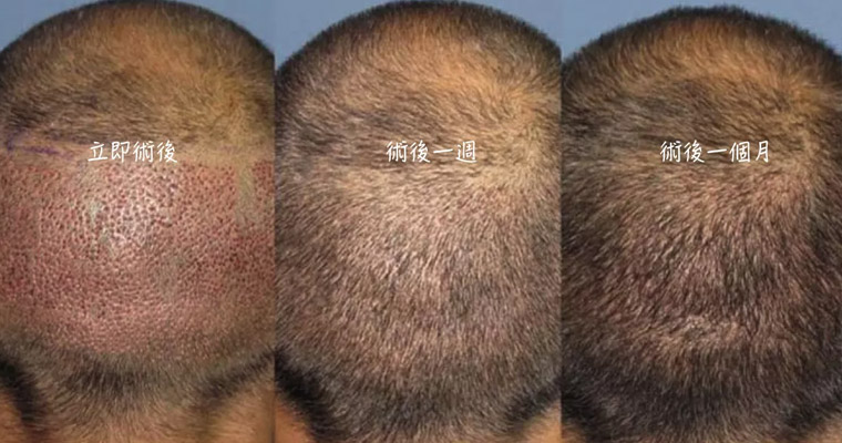 另一種植髮失敗