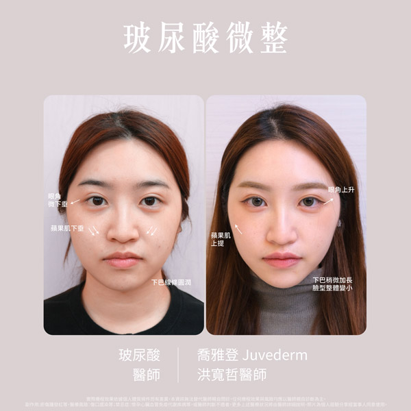 Jessica之前豐唇失敗