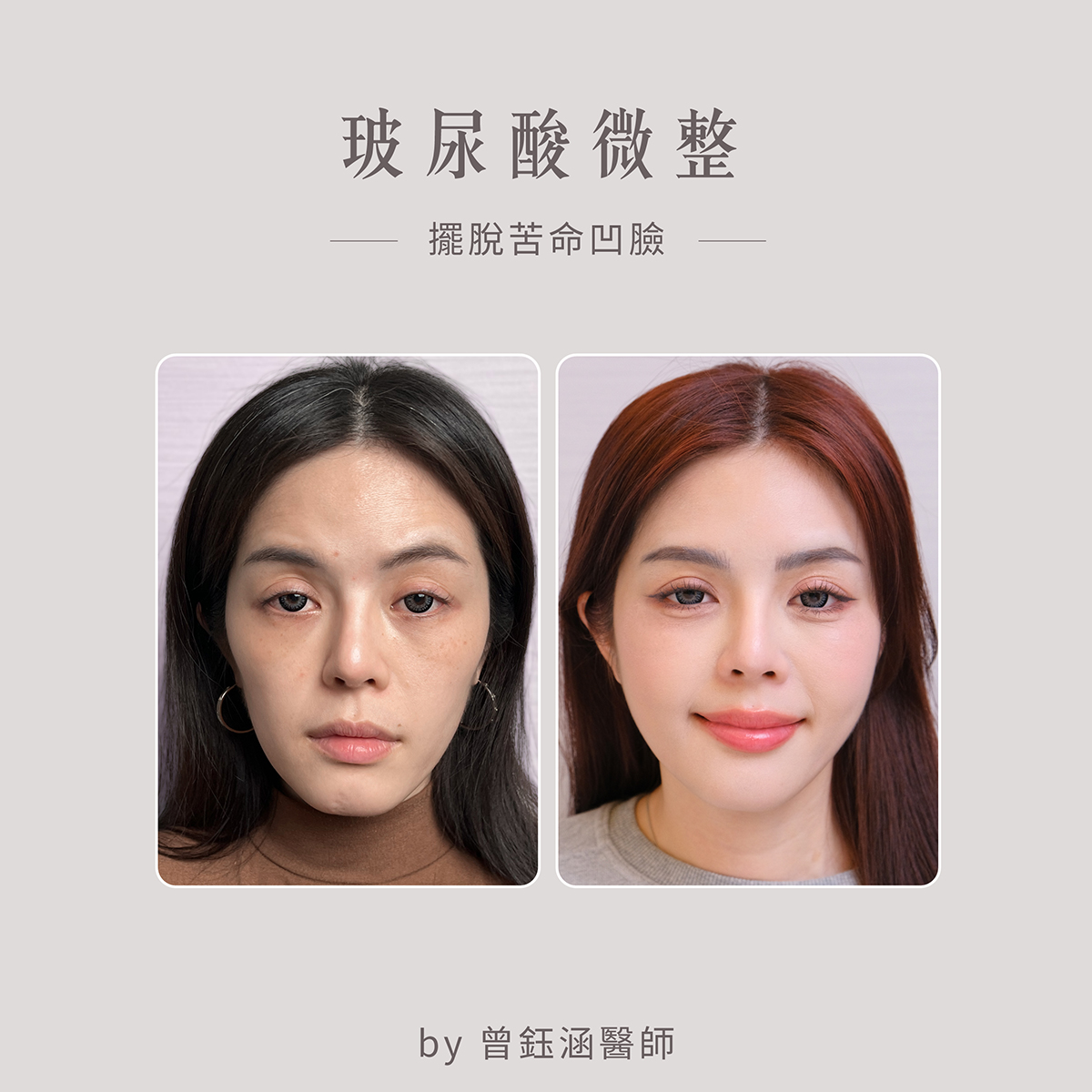 素人羅玲術前術後比一比