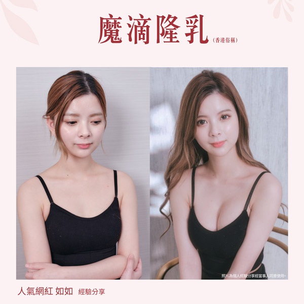 魔滴隆乳術後三個月