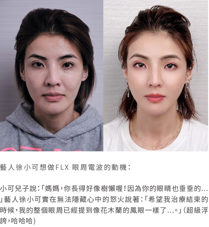 徐小可鳳凰碧眼經驗分享