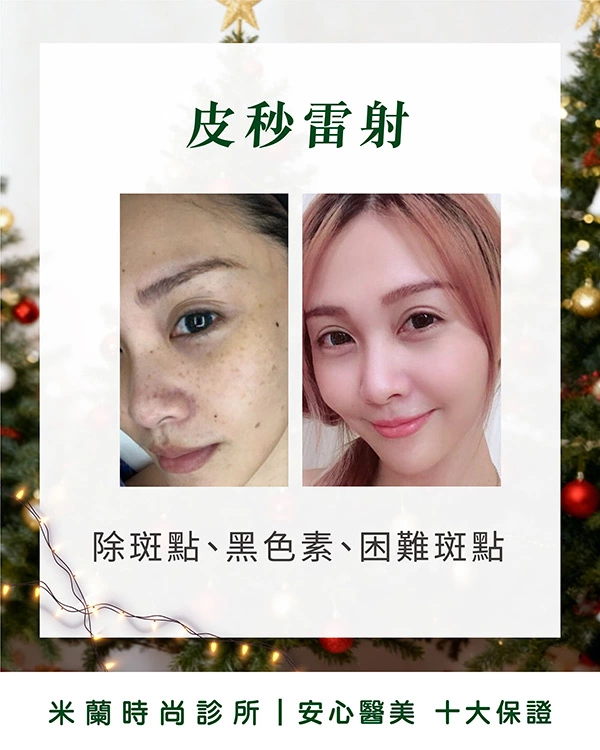 皮秒雷射術後10天真實記錄