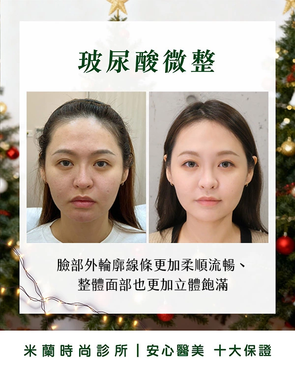 素人子怡術前術後比一比