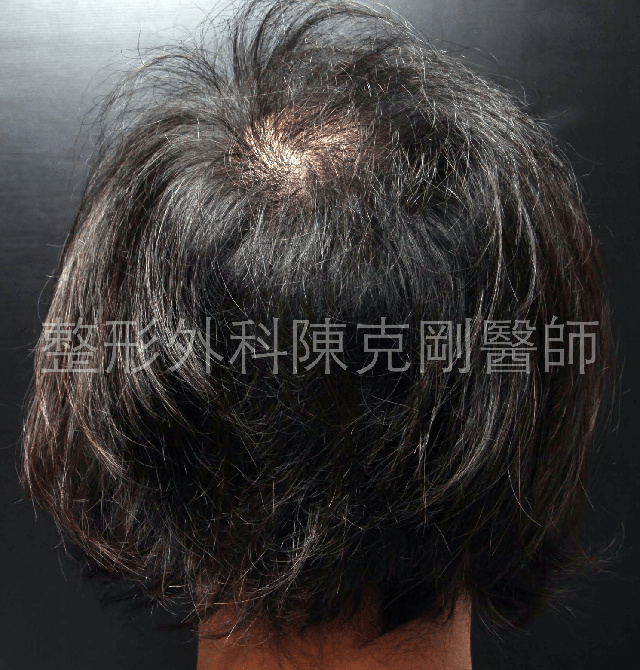FUE寇約翰植髮術前照片