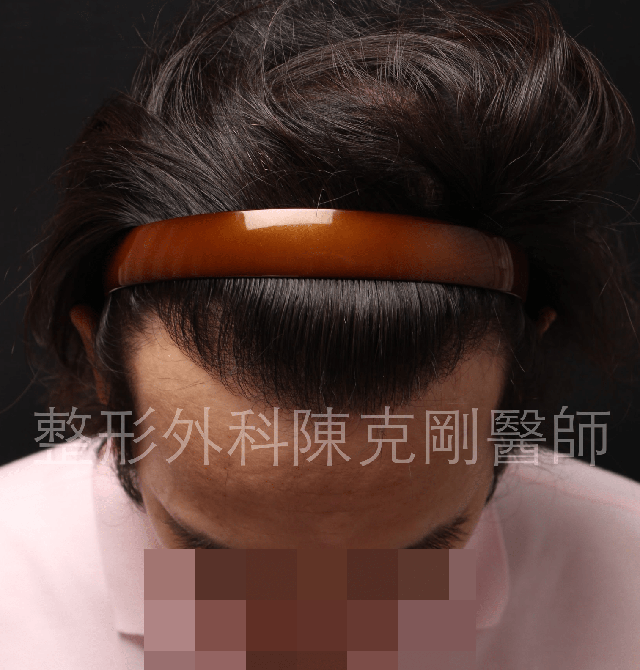 FUE寇約翰植髮術前照片