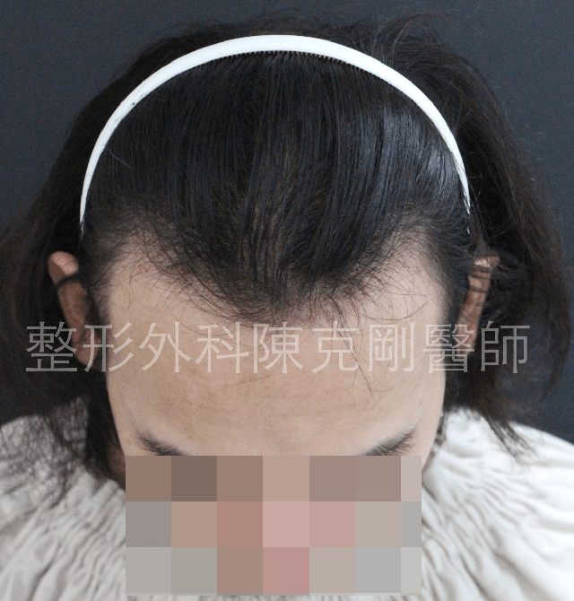 FUE寇約翰植髮術前照片