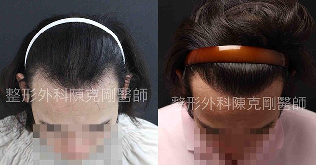 FUE寇約翰植髮術前術後兩相對比之下
