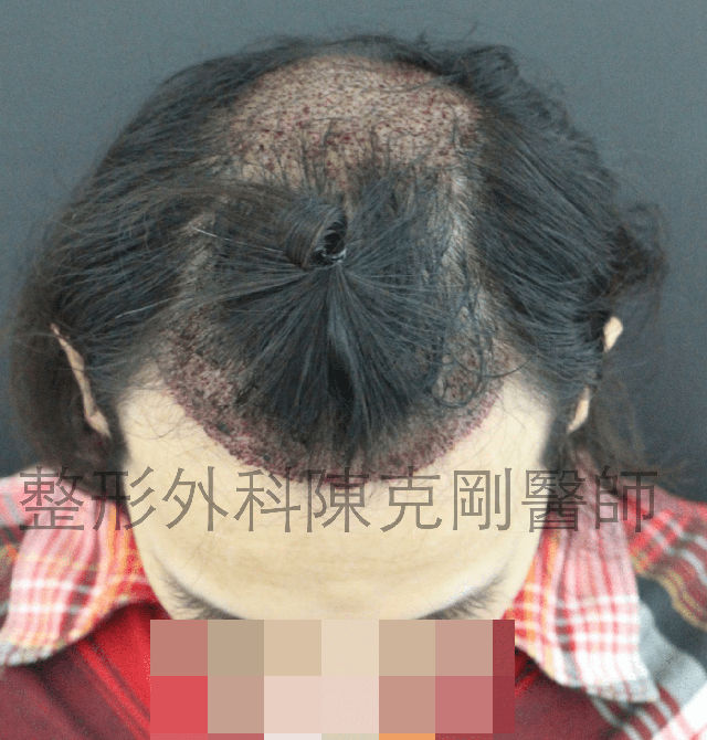FUE寇約翰植髮術前照片