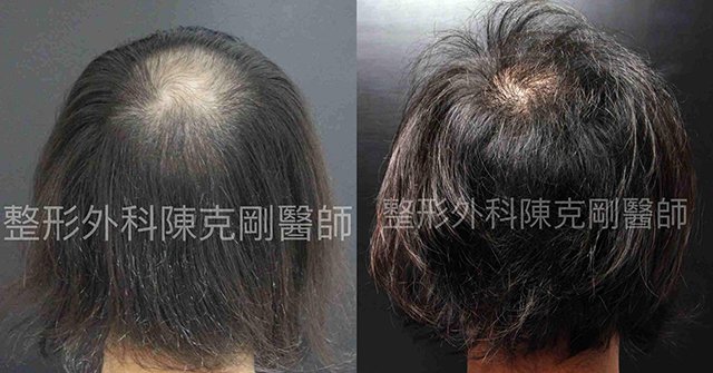 FUE寇約翰植髮術前術後兩相對比之下